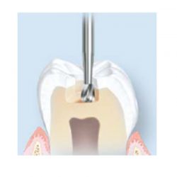 Fresa Carbide Pera – A/V – C/A
