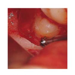 Fresa Redonda Carbide Para Cirugía – C/A – P/M